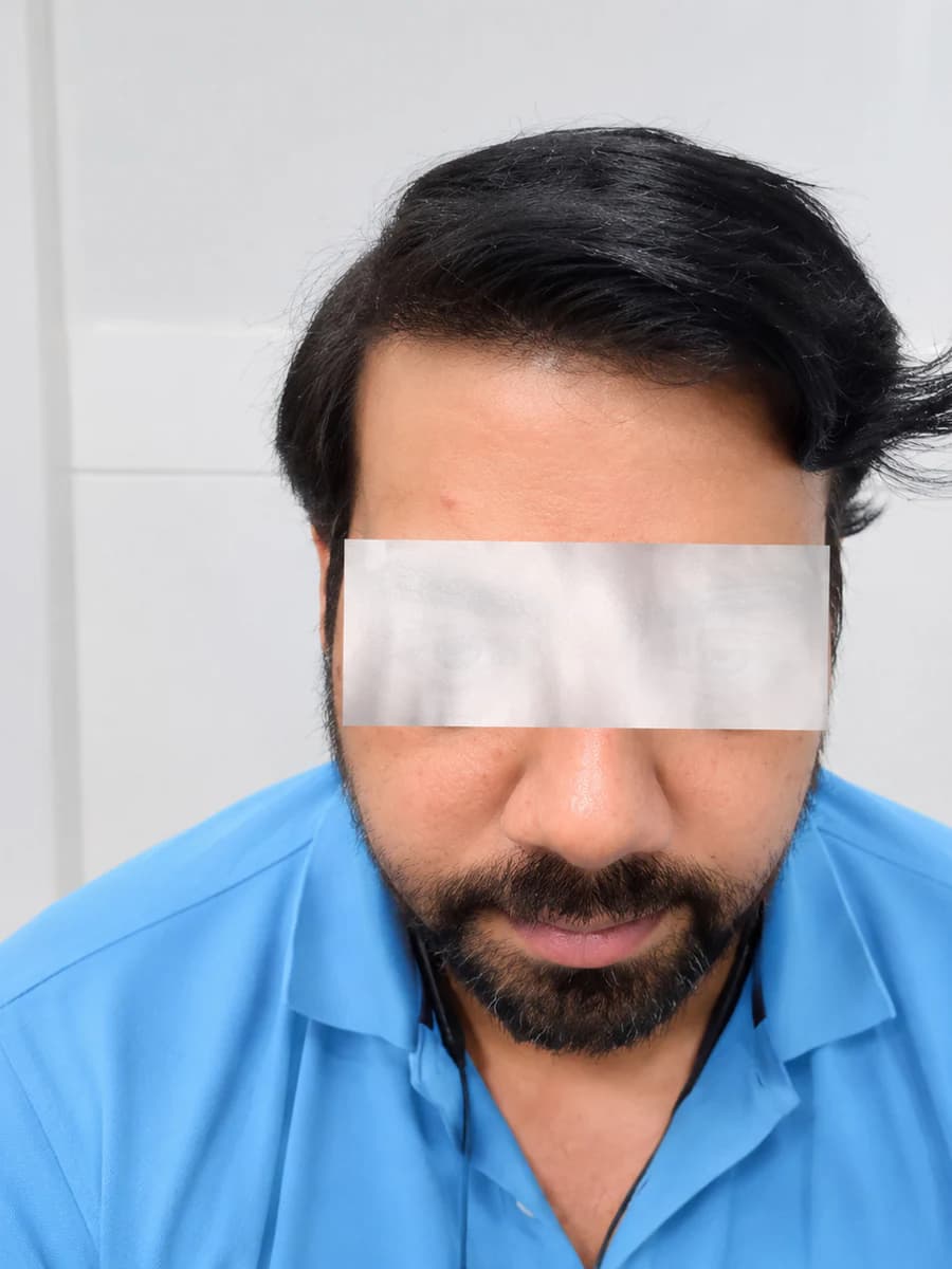 hair transplant case 001 front after