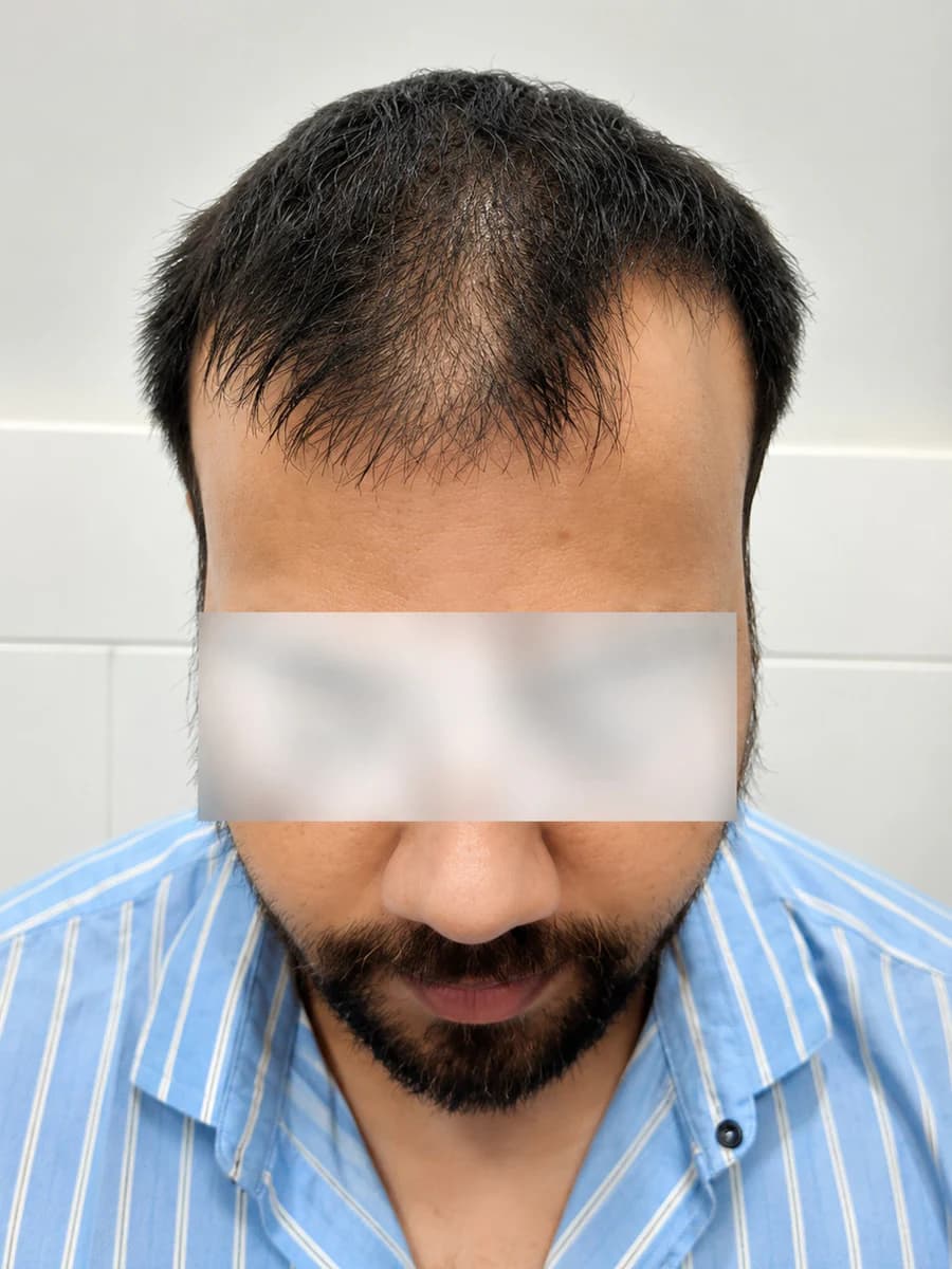 hair transplant case 001 front before