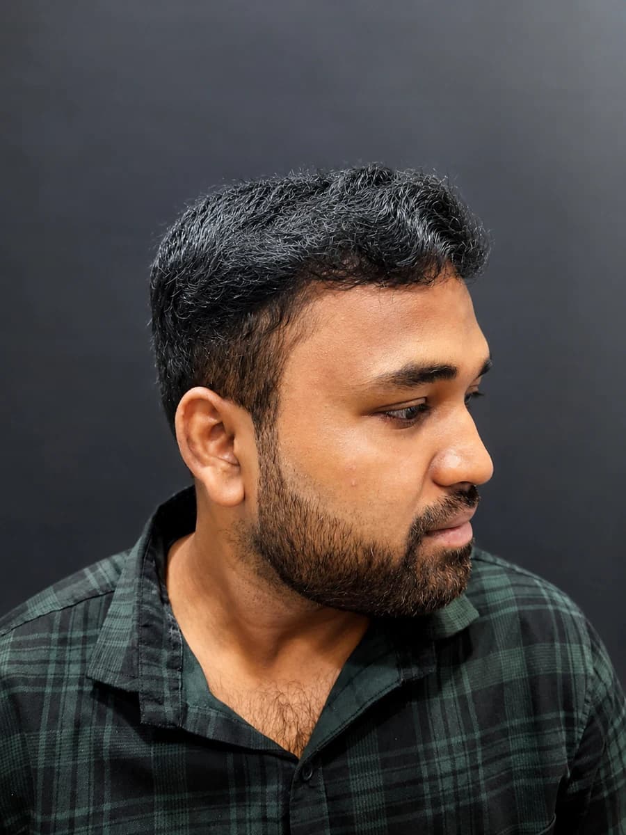 hair transplant case 007 angle after